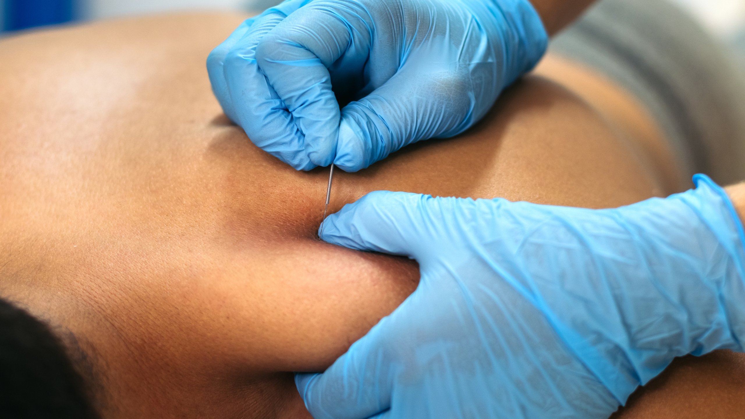 Dry needling